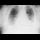 Chronic lung congestion, Kerley B lines, pleural effusion, aortomitral valvular disease: X-ray - Plain radiograph